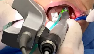 Denacam Handstück mit Kamera und Marker im Mund des Patienten (Bildvorlage Prof. Dr. Huth).
