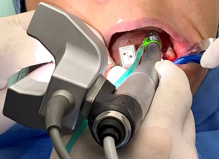 Abb. 5b: Denacam Handstück mit Kamera und Marker im Mund des Patienten.