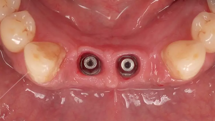 Abb. 5: Zustand zum Zeitpunkt der provisorischen Versorgung im Unterkiefer.