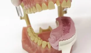 Überprüfung der störungsfreien Passung im
Patientenmund.