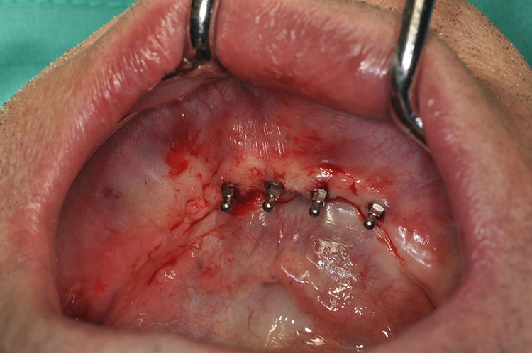 Abb. 5: Minimalinvasive Direktinsertion der Miniimplantate „flapless“ ohne Lappenbildung.