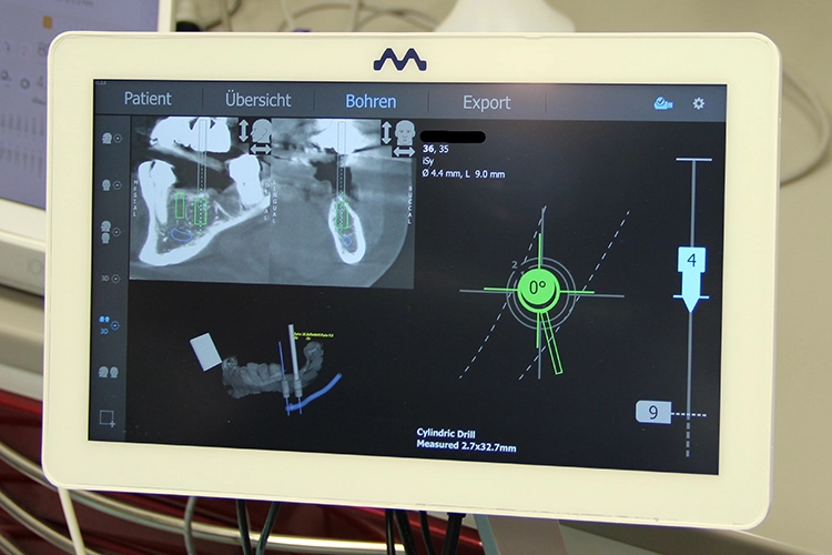 Abb. 5: Intraoperative Anzeige der dynamischen Navigation: Bohrerposition, Winkel und Tiefe werden in Echtzeit dargestellt.
