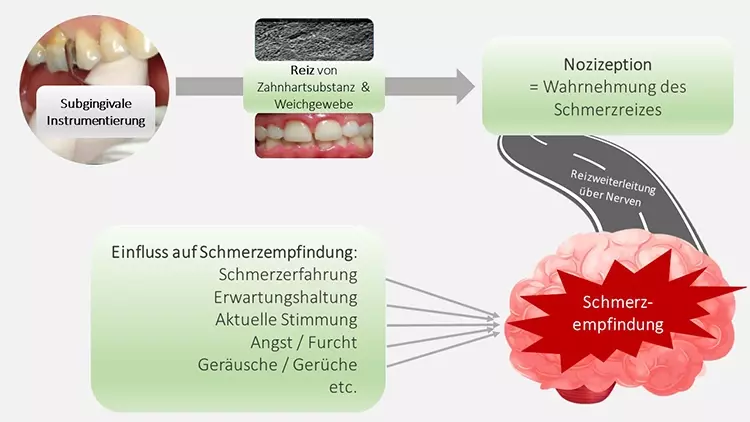 Abb. 5: Schmerz bei der subgingivalen Instrumentierung. Neben der Nozizeption in den anatomischen
Strukturen Zahnhart- und Weichgewebe nimmt die Verarbeitung des Schmerzreizes im Gehirn durch verschiedene
Faktoren einen großen Einfluss auf die Intensität der Schmerzempfindung.