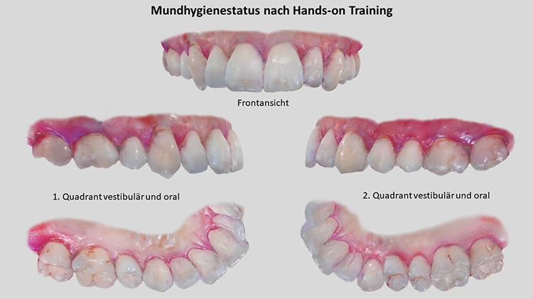 Abb. 5: Bilder vom 3D-Intraoralscan mit dem Mundhygienestatus 6 Monate nach
dem Hands-on-Training. Vor allem oral konnte eine deutliche Verbesserung der
Mundhygiene erreicht werden. Die distalen Flächen der Molaren sind aufgrund der
beengten Platzverhältnisse nur schwer erreichbar. Im nächsten Schritt sollte versucht
werden, durch gezielte Instruktion die Interdentalraumhygiene zu verbessern.