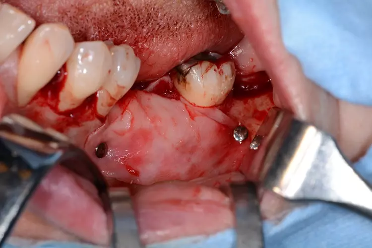 5b: Abdeckung der Augmentation mit Membran und Lagestabilisierung mit Pins.