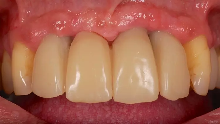 Abb. 6: Provisorische Versorgung im Oberkiefer.