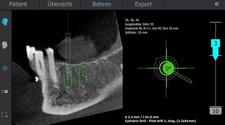 Abb. 6: Dreidimensionale Echtzeitdarstellung der Bohrerposition während der Operation, zusätzlich Fadenkreuz als „Zielvorrichtung“ sowie dynamische Angabe der Angulation/Positionsabweichung und Tiefenbohrung.