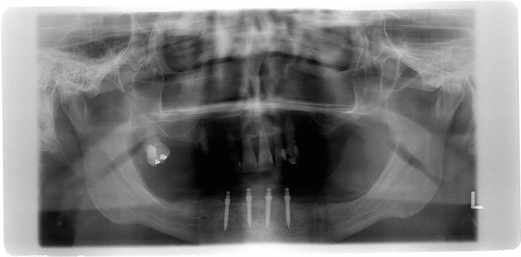 Abb. 6: Postoperative Panoramaschichtaufnahme.
