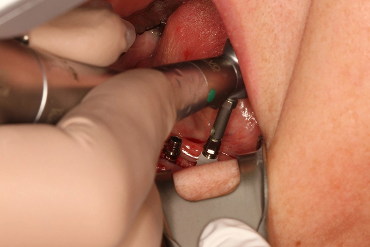 Abb. 6: Implantatinsertion 36 und Implantat 35 in situ.