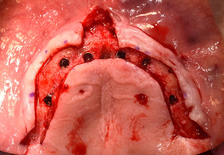 Abb. 6: Navigierte Führungsschablone links; rechts nach crestaler Schnittführung und Bildung eines Mukoperiostlappens
Implantation von sechs Straumann® BLX Implantate im Oberkiefer.