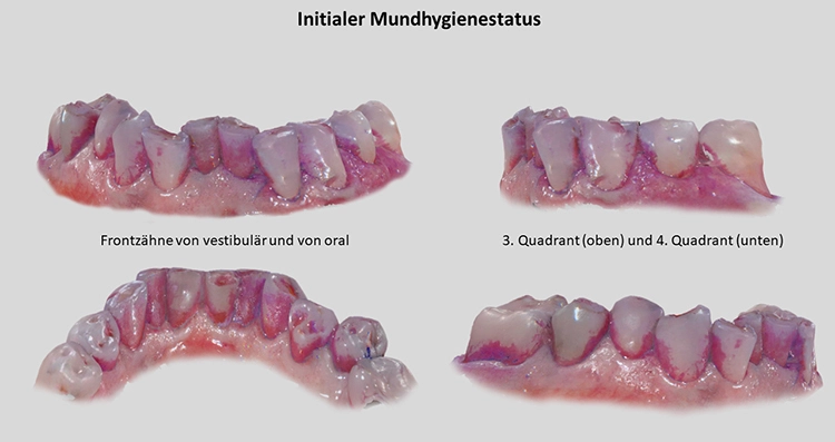 Abb. 6: Bilder vom 3D-Intraoralscan mit initialem Mundhygienestatus nach habituellem
Zähneputzen. Aufgrund eines ausgeprägten Würgereizes ist die eigene
Mundhygienefähigkeit vor allem im Unterkiefer nur eingeschränkt möglich.
Zahn 46 konnte aufgrund des Würgereizes nicht vollständig gescannt werden.