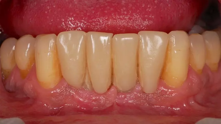 Abb. 7: Provisorische Versorgung im Unterkiefer.