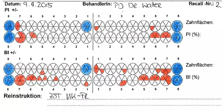 Abb. 7: 3 Wochen nach der professionellen Zahnreinigung und Mundhygieneinstruktion zeigte sich bereits eine deutliche Besserung der Plaque- (10,5%) und Blutungsindizes (21%). Die Patientin wurde instruiert, vor allem die lingualen Unterkieferseiten und die Interdentalräume noch intensiver zu reinigen. Die Größe der Interdentalbürsten wurde angepasst.