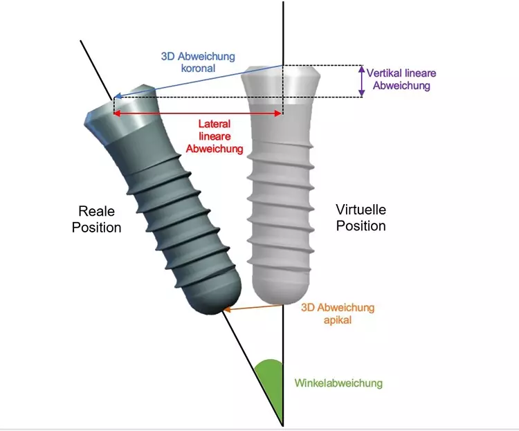 Abb. 7: Räumliche Abweichung der virtuell
präoperativ geplanten und realen postoperativen
Implantatposition.