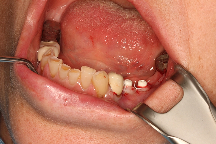 Abb. 7: Implantate mit Gingivaformern und dicht vernähtem Weichgewebe.