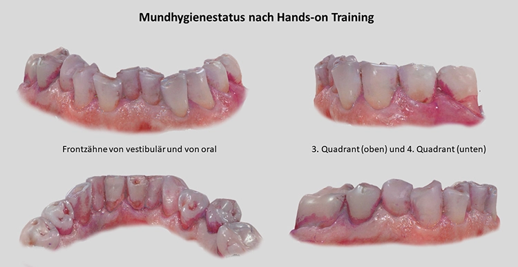 Abb. 7: Bilder vom 3D-Intraoralscan mit dem Mundhygienestatus 6 Monate
nach dem Hands-on-Training. Nach der Visualisierung im 3D-Scan und
anschließender Instruktion sowie einem Hands-on-Training konnte die
Mundhygiene trotz ausgeprägtem Würgereflex deutlich verbessert werden.