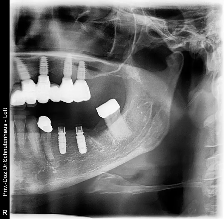Abb. 8: Postoperatives Röntgenbild.