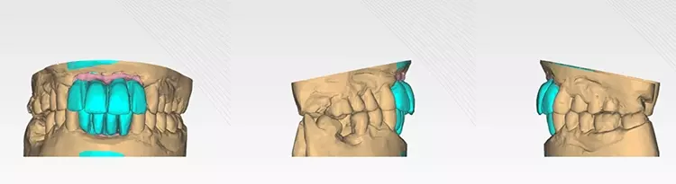 Abb. 8 Virtuelle Planung des Ober- und Unterkieferzahnersatzes.