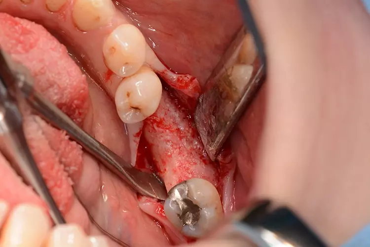 Abb. 8: Intraoperative Ansicht sechs Monate nach Augmentation; es zeigt sich eine suffiziente Knochenbreite und ein gut vaskularisiertes Augmentat.