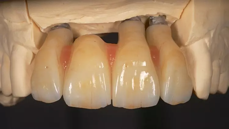 Abb. 9: Oberkiefer-Rekonstruktion nach Fertigstellung im Dentallabor, Ansicht
von vestibulär.