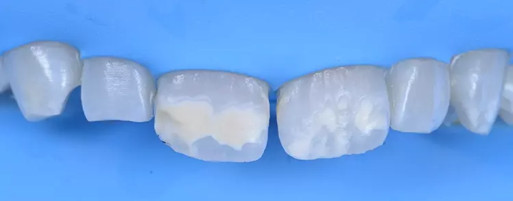 Abb. 9: Mechanische Oberflächenentfernung an 11.