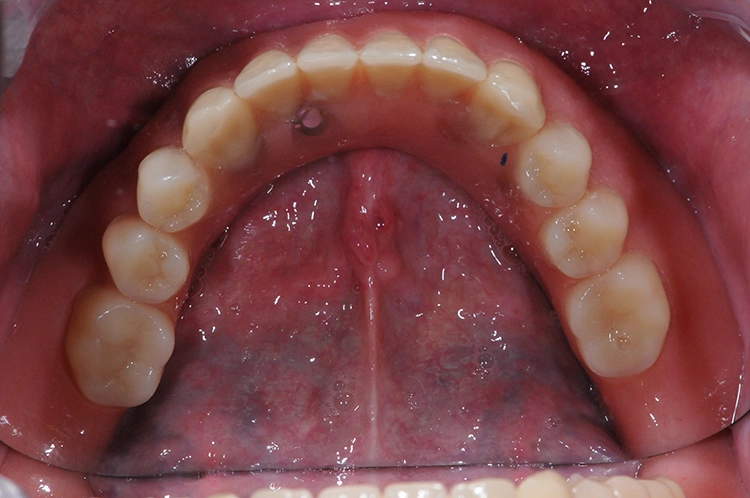 Abb. 9: Eingegliederte Prothese.
