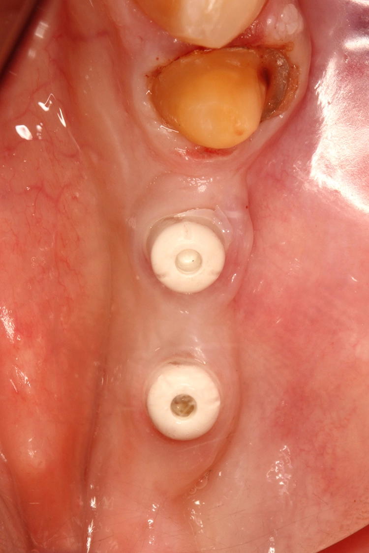 Abb. 9: Klinische Situation vier Monate nach Implantation und mit aufgesteckten Scanbodys.