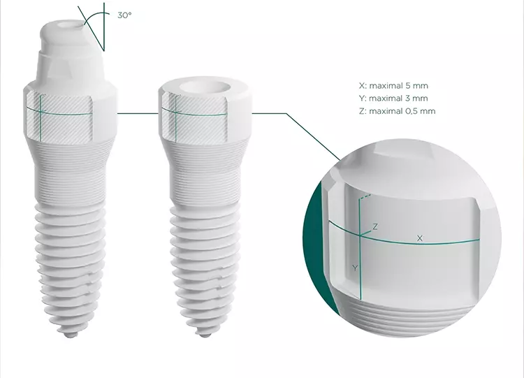 Abb. 4: Aufbereitungsschema des einteiligen SDS 1.2 Implantats in der Implantatschulter, dem sichtbaren/
ästhetischen Bereich, der eine optimale Anpassung an den Verlauf der Gingiva bietet. Der Außendurchmesser
der Implantatschulter kann um maximal 0,5 mm reduziert werden. Horizontal (Y-Achse)
konnte die Implantatschulter um maximal 3 mm bis zum Beginn des dünnen Drahtes reduziert werden.
Im Bereich des Schulterradius an der Präparationsgrenze betrug die Ausdehnung nicht mehr als 5 mm.
Das SDS 1.2 Implantat kann problemlos bis zu einem Winkel von 30° beschliffen werden.