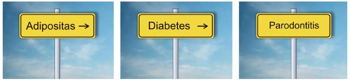 Indirekter Einfluss von Adipositas auf Parodontitis über Diabetes mellitus.