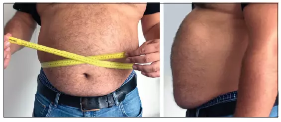 Abb. 1: Abdominale Adipositas.
