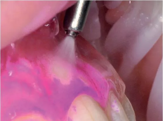 Minimalinvasive Pulver können ohne Risiko zur Weichgewebsreinigung eingesetzt werden.