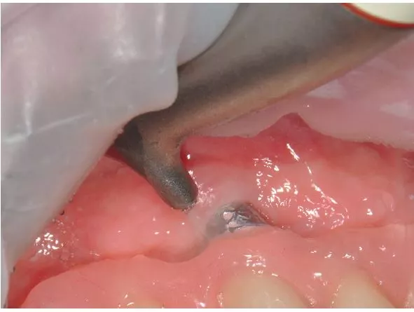 Abb. 6: Auch für die Reinigung von Implantatoberflächen und Suprastrukturen kann AIRFLOW® eingesetzt werden, wiederum mit entsprechend schonenden Pulvern.