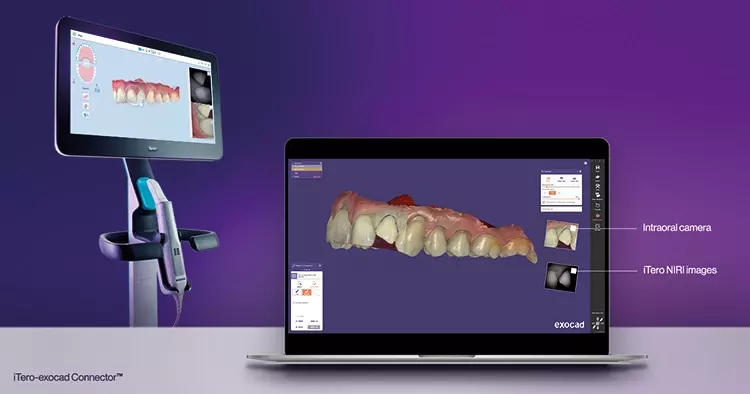 „Mit dem iTero-exocad Connector ist das Zurücksenden von Scans ans Labor unkompliziert möglich“, so Dr. Ingo Baresel.