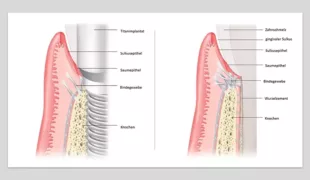 Abb. 1: Vergleich der Morphologie an Implantat und Zahn (modifiziert nach [17]).