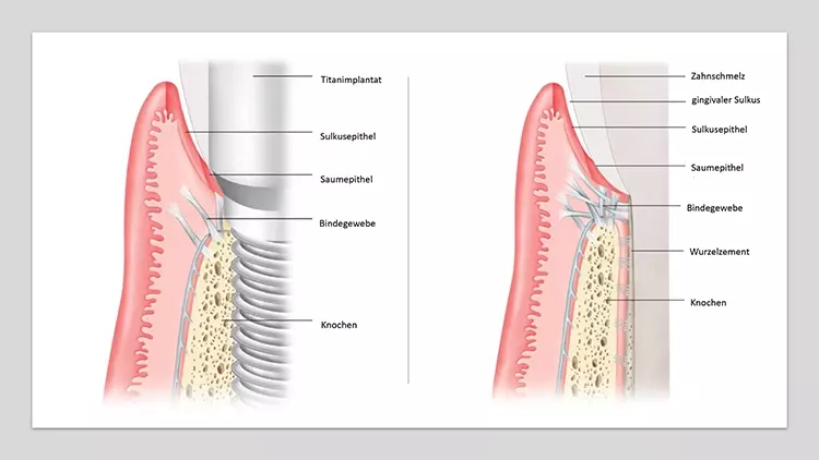 Abb. 1: Vergleich der Morphologie an Implantat und Zahn (modifiziert nach [17]).
