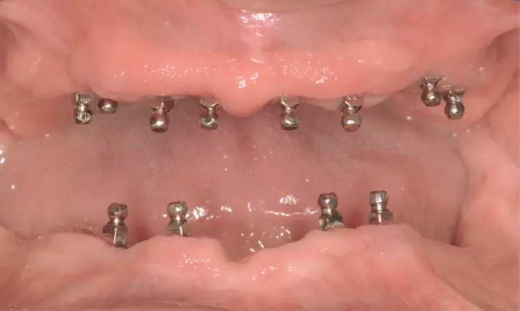 Abb. 1: Mini-Implantate in situ.