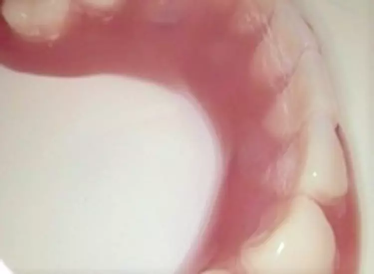 Abb. 9: Chirurgie und Prothetik funktionieren prinzipiell auch im Oberkiefer, wobei dort besser die blauen O-Ringe in den MMT-Matrizen zur Anwendung gelangen, um Hebel beim Ausziehen der Prothese durch einen zu starken Halt (mit braunen O-Ringen) zu vermeiden