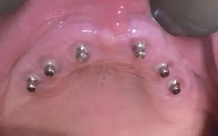 Abb. 10: Chirurgie und Prothetik funktionieren prinzipiell auch im Oberkiefer, wobei dort besser die blauen O-Ringe in den MMT-Matrizen zur Anwendung gelangen, um Hebel beim Ausziehen der Prothese durch einen zu starken Halt (mit braunen O-Ringen) zu vermeiden