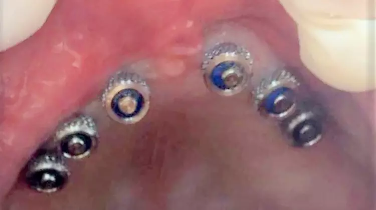 Abb. 12: Chirurgie und Prothetik funktionieren prinzipiell auch im Oberkiefer, wobei dort besser die blauen O-Ringe in den MMT-Matrizen zur Anwendung gelangen, um Hebel beim Ausziehen der Prothese durch einen zu starken Halt (mit braunen O-Ringen) zu vermeiden