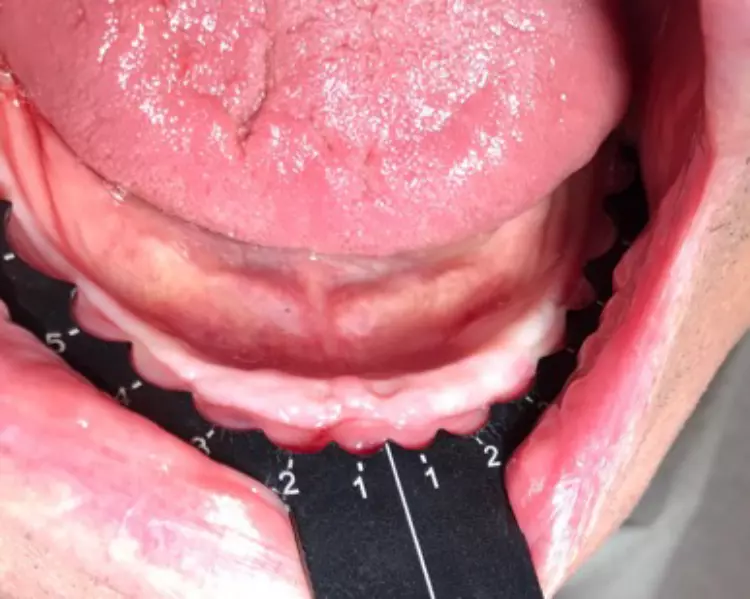 Abb. 3: Mit den Champions Implantat Guides kann man auch bei einem zahnlosen Kiefer die ideale Implantatposition finden.