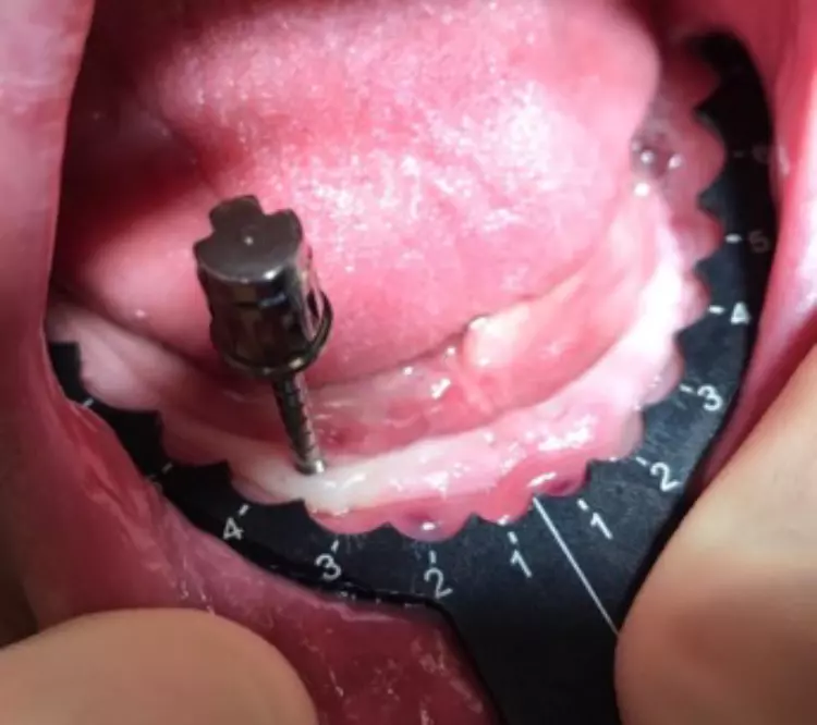 Abb. 4: Mit den Champions Implantat Guides kann man auch bei einem zahnlosen Kiefer die ideale Implantatposition finden.