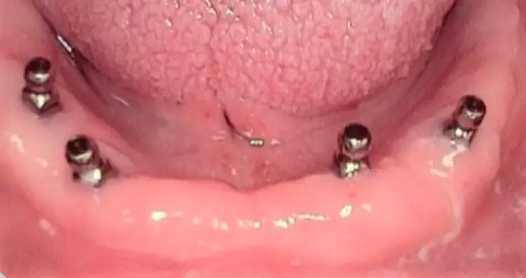 Abb. 5: Das regio 34 aufbereitete Implantat ist ca. 2 mm zu weit bukkal aufbereitet und inseriert
worden. Die bukkale Knochenwand ist relativ dünn und die Matrize könnte in der Prothese ästhetische
Probleme verursachen. Die Implantatpositionierungen in regio 32 und 44 sind dagegen perfekt.
