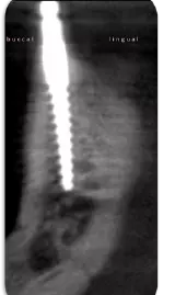 Abb. 6: Das regio 34 aufbereitete Implantat ist ca. 2 mm zu weit bukkal aufbereitet und inseriert
worden. Die bukkale Knochenwand ist relativ dünn und die Matrize könnte in der Prothese ästhetische
Probleme verursachen. Die Implantatpositionierungen in regio 32 und 44 sind dagegen perfekt.