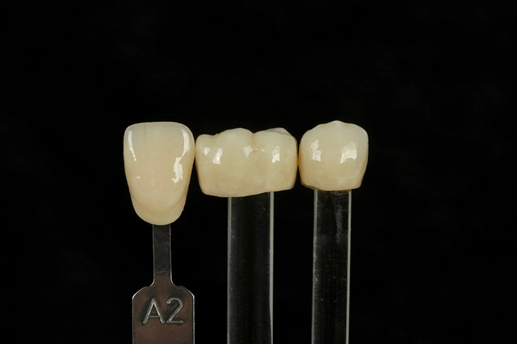 Bilder aus der Dokumentation der Siegerarbeit von Abd Alazez Alajaj (Andreas Piorreck Zahntechnik): Monolithische Zirkonoxidkronen („KATANA Zirconia“ STML).