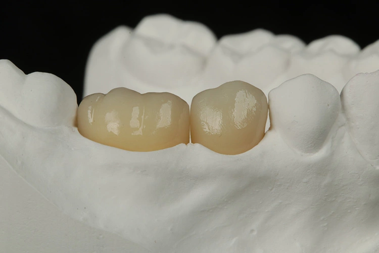Bilder aus der Dokumentation der Siegerarbeit von Abd Alazez Alajaj (Andreas Piorreck Zahntechnik): Monolithische Zirkonoxidkronen („KATANA Zirconia“ STML).