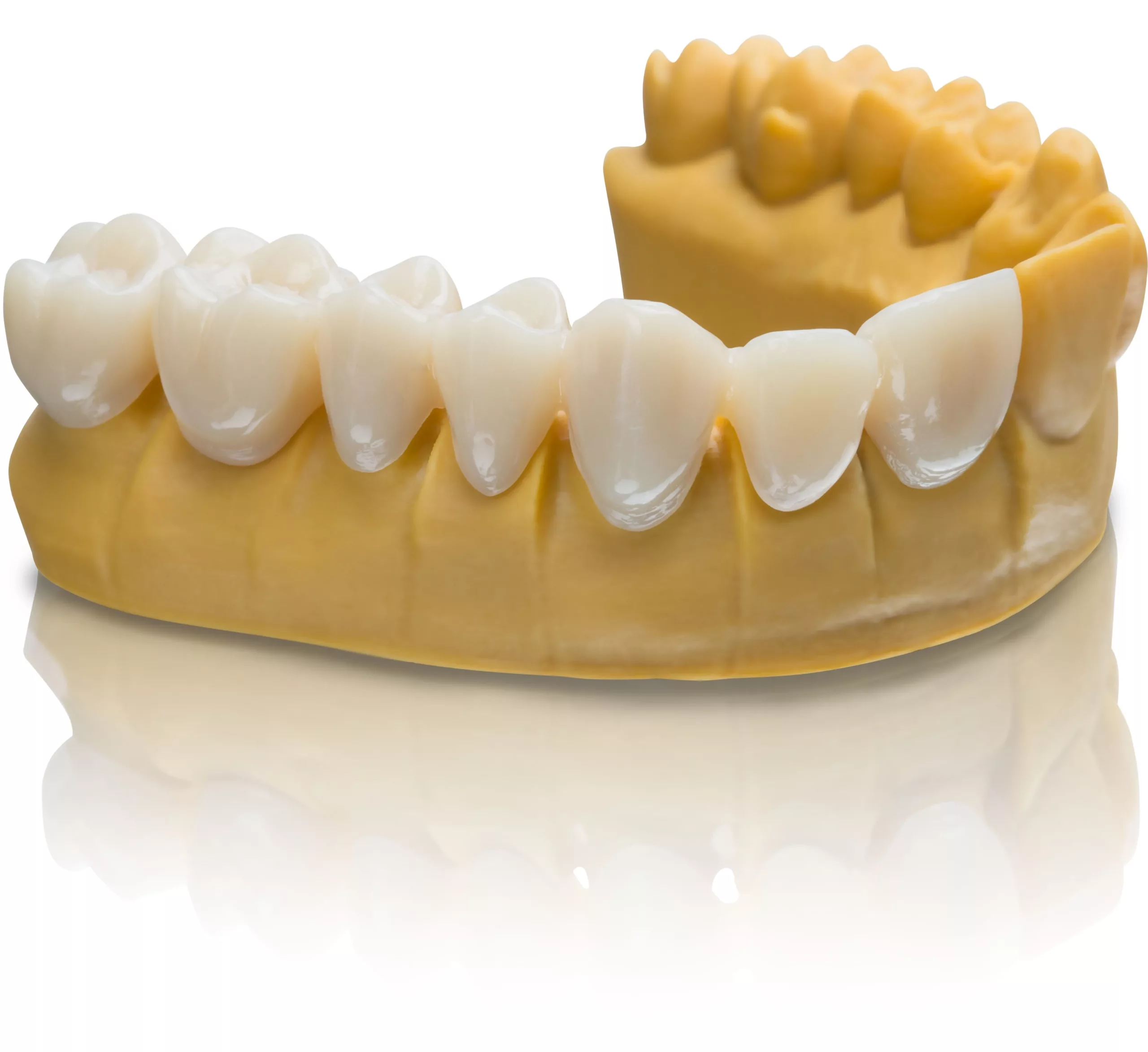 VarseoSmile Temp ist optimal für den 3D-Druck von temporären Kronen und Brücken, Inlays, Onlays und Veneers geeignet.