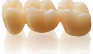 Ab sofort bei BEGO in 13 Farben erhältlich: hochästhetische Versorgungen aus KATANA Zirconia STML.