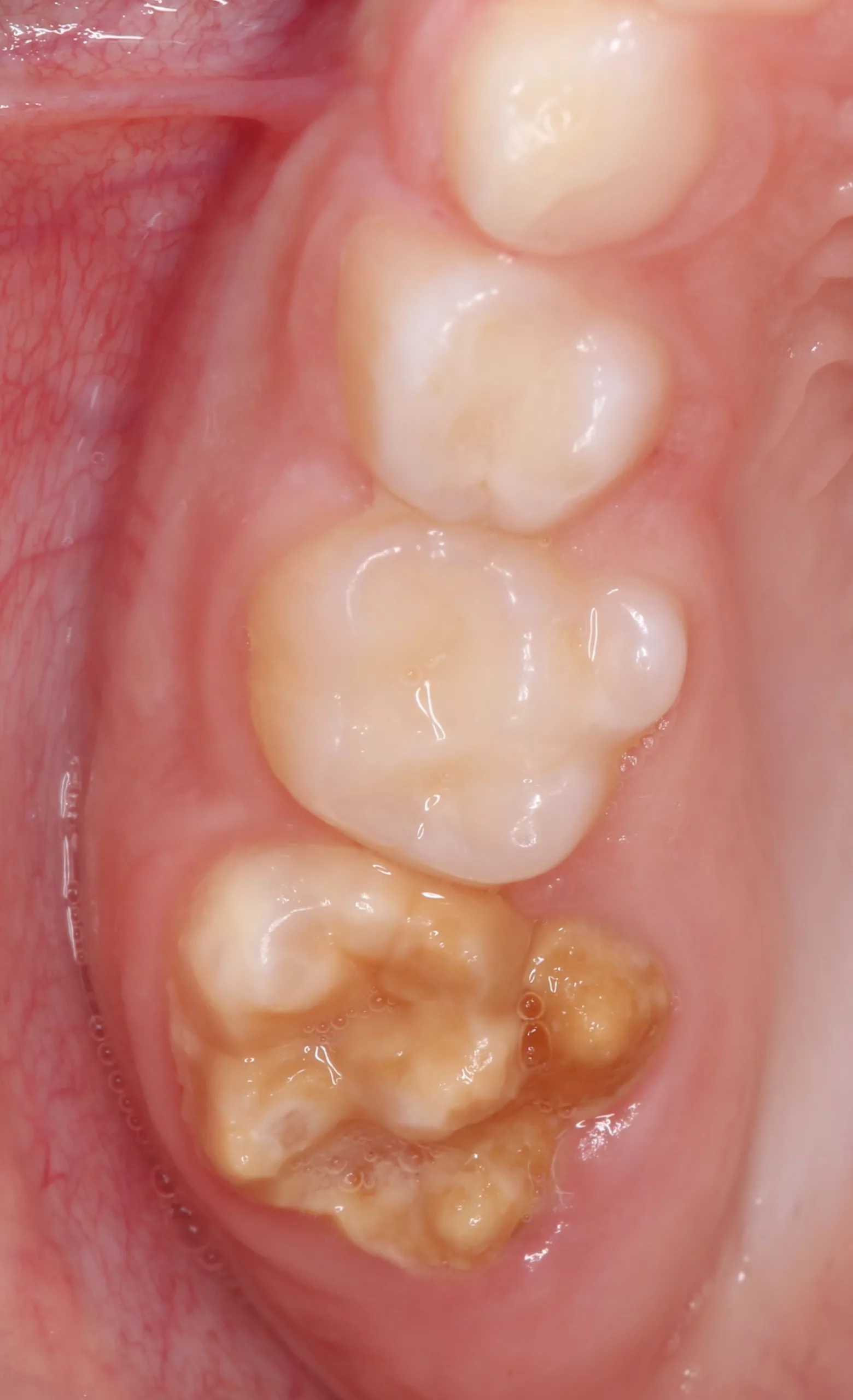 Abb. 1: MIH am Zahn 16.