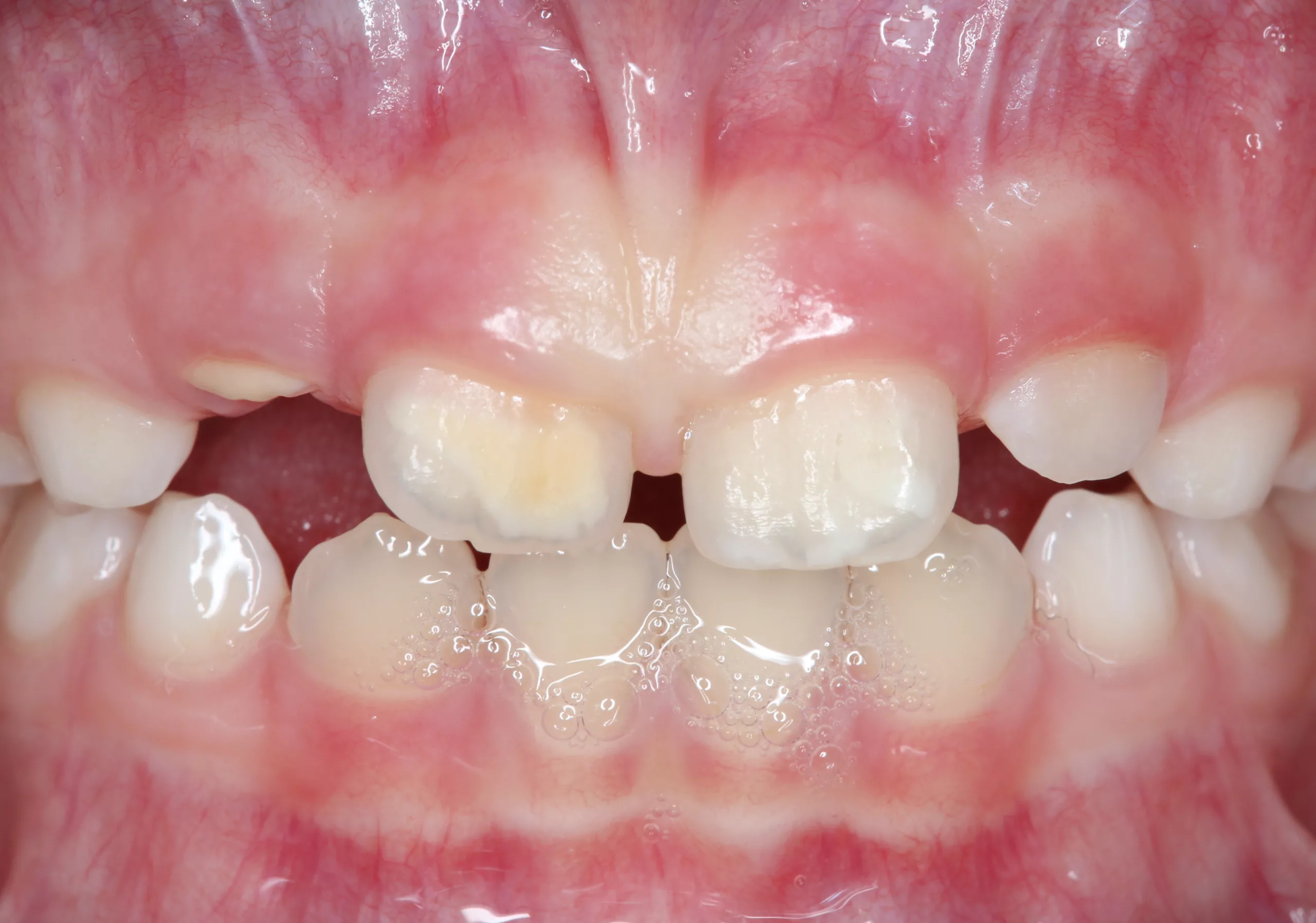 Abb. 2: MIH an den Zähnen 11 und 21.