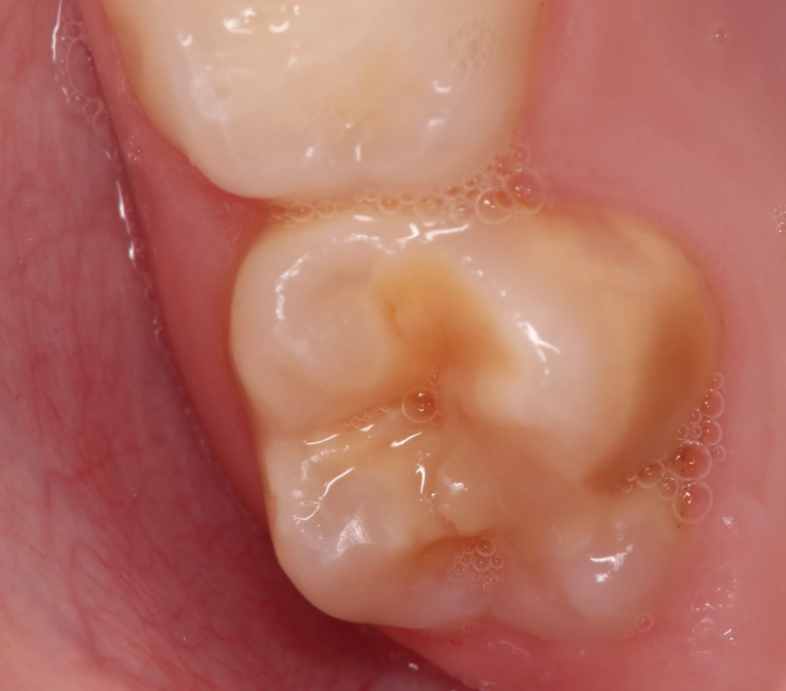 Abb. 3: Molaren-Inzisiven-Hypomineralisation Schweregrad 1.